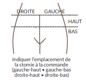 Emplacement de la stomie